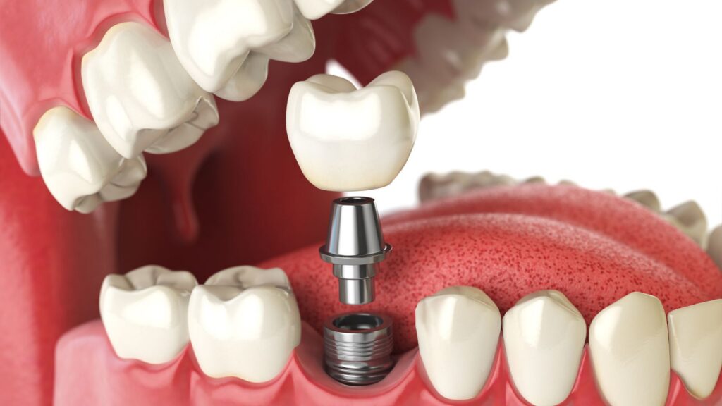 Personalized Treatment Plans for Dental Implants in Kennewick and Richland